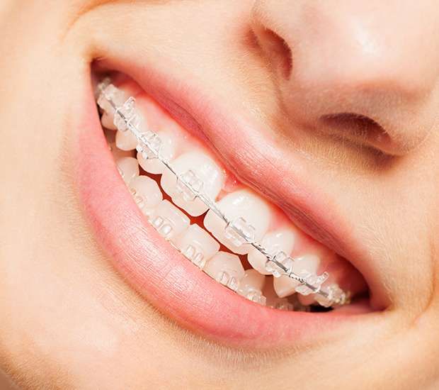 Grand Rapids Clear Braces