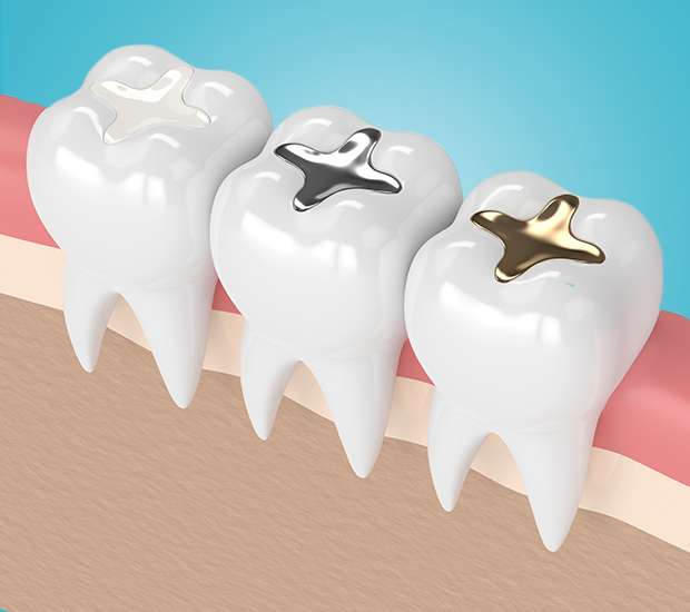 Grand Rapids Composite Fillings
