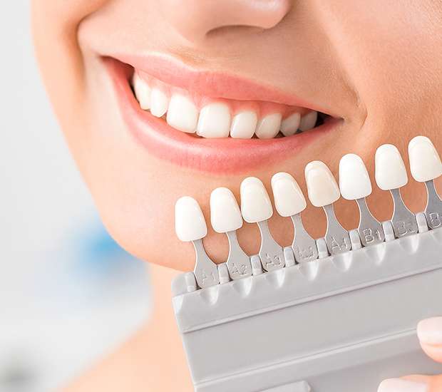 Grand Rapids Dental Veneers and Dental Laminates