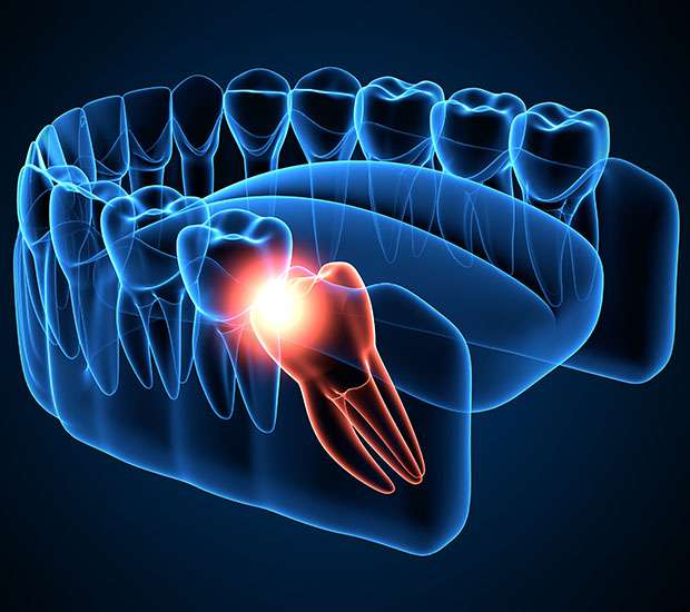 Grand Rapids Wisdom Teeth Extraction
